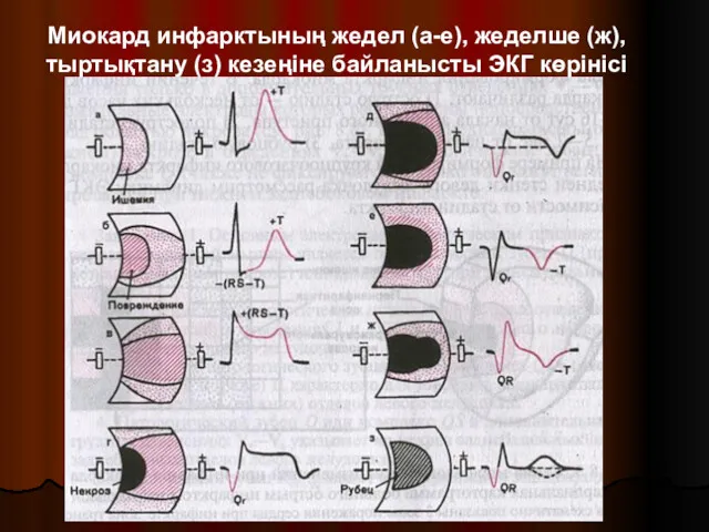 Миокард инфарктының жедел (а-е), жеделше (ж), тыртықтану (з) кезеңіне байланысты ЭКГ көрінісі