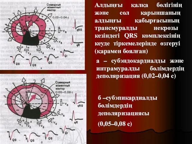 а – субэндокардиалды және интрамуралды бөлімдердің деполяризация (0,02–0,04 с) б –субэпикардиалды бөлімдердің деполяризациясы
