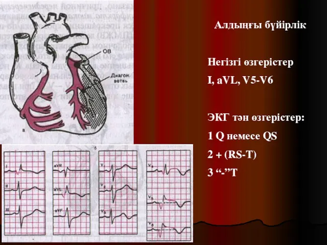 Алдыңғы бүйірлік Негізгі өзгерістер I, aVL, V5-V6 ЭКГ тән өзгерістер: 1 Q немесе