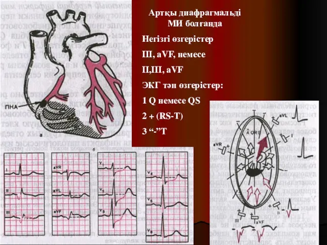 Артқы диафрагмальді МИ болғанда Негізгі өзгерістер III, aVF, немесе II,III, aVF ЭКГ тән