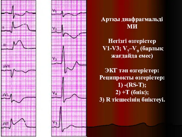 Артқы диафрагмальді МИ Негізгі өзгерістер V1-V3; V7–V9 (барлық жағдайда емес) ЭКГ тән өзгерістер: