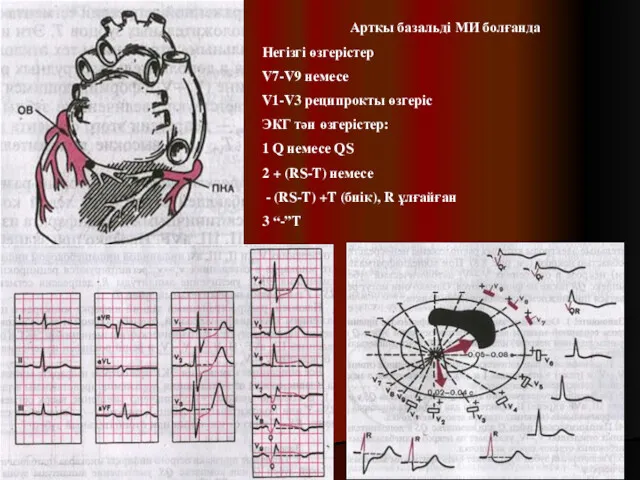 Артқы базальді МИ болғанда Негізгі өзгерістер V7-V9 немесе V1-V3 реципрокты өзгеріс ЭКГ тән