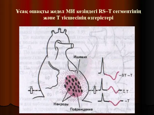 Ұсақ ошақты жедел МИ кезіндегі RS–T сегментінің және Т тісшесінің өзгерістері