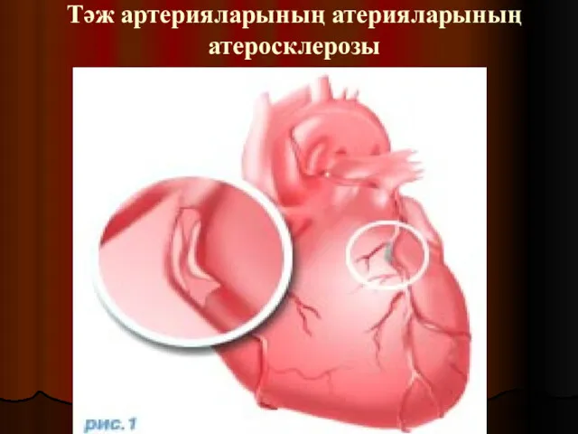 Тәж артерияларының атерияларының атеросклерозы
