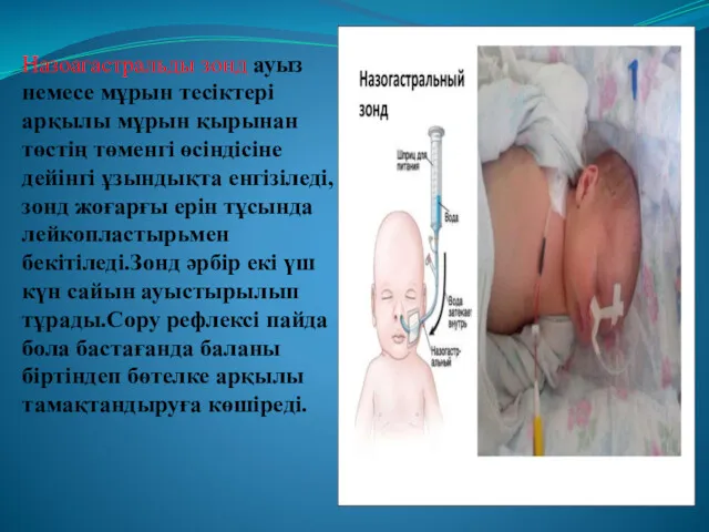 Назоагастральды зонд ауыз немесе мұрын тесіктері арқылы мұрын қырынан төстің