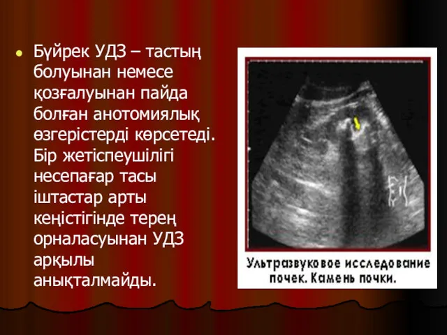 Бүйрек УДЗ – тастың болуынан немесе қозғалуынан пайда болған анотомиялық өзгерістерді көрсетеді. Бір