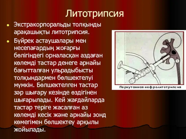 Литотрипсия Экстракорпоральды толқынды арақашықты литотрипсия. Бүйрек астаушалары мен несепағардың жоғарғы