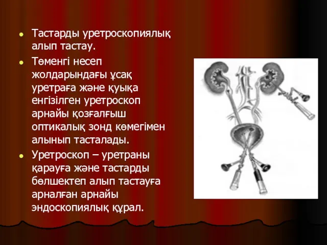 Тастарды уретроскопиялық алып тастау. Төменгі несеп жолдарындағы ұсақ уретраға және