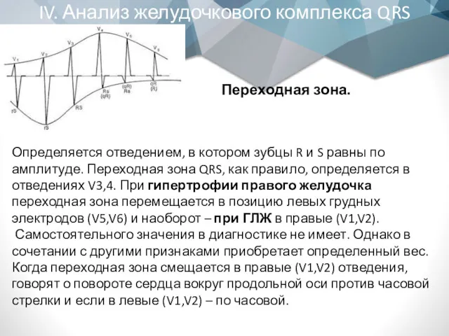 IV. Анализ желудочкового комплекса QRS Переходная зона. Определяется отведением, в