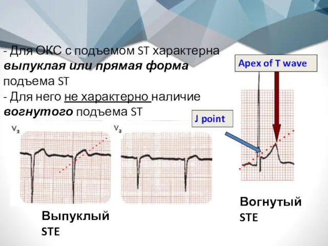 J point Apex of T wave Вогнутый STE Выпуклый STE
