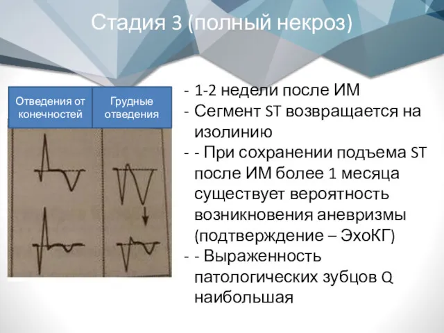 Стадия 3 (полный некроз) 1-2 недели после ИМ Сегмент ST