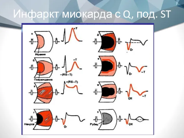 Инфаркт миокарда с Q, под. ST