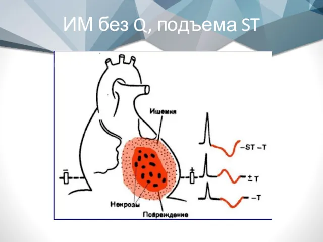 ИМ без Q, подъема ST