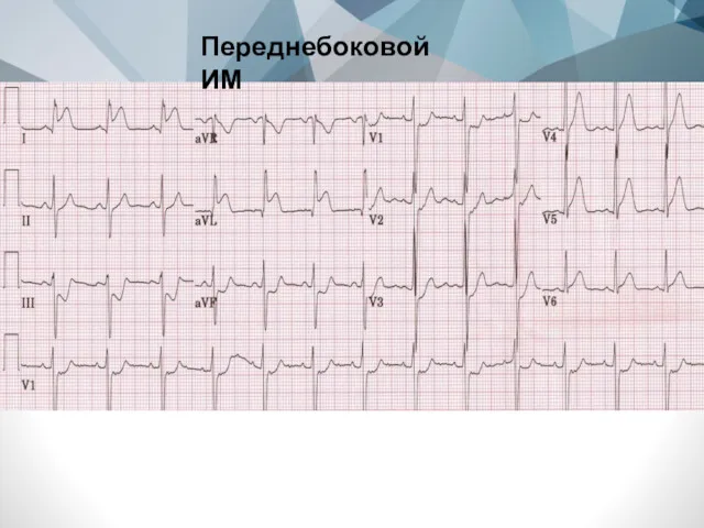 Переднебоковой ИМ