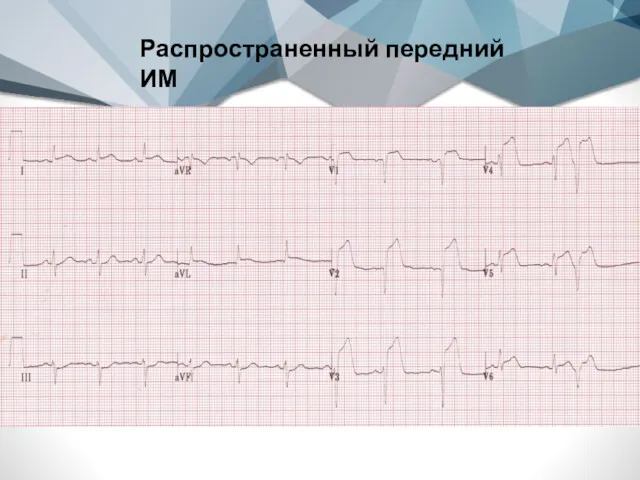 Распространенный передний ИМ