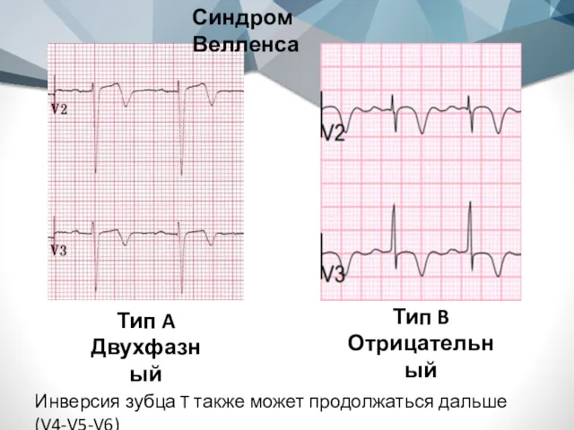 Синдром Велленса Тип A Двухфазный Тип B Отрицательный Инверсия зубца T также может продолжаться дальше (V4-V5-V6)