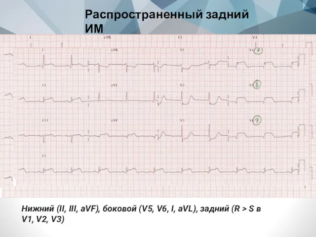 Распространенный задний ИМ Нижний (II, III, aVF), боковой (V5, V6,