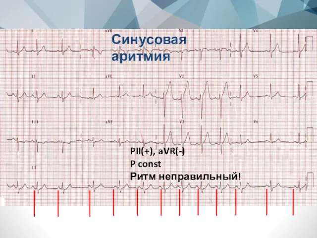 Синусовая аритмия PII(+), aVR(-) P const Ритм неправильный!