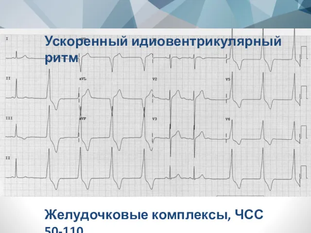 Ускоренный идиовентрикулярный ритм Желудочковые комплексы, ЧСС 50-110