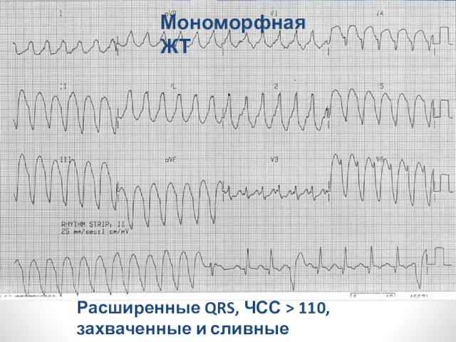 Расширенные QRS, ЧСС > 110, захваченные и сливные комплексы Мономорфная ЖТ