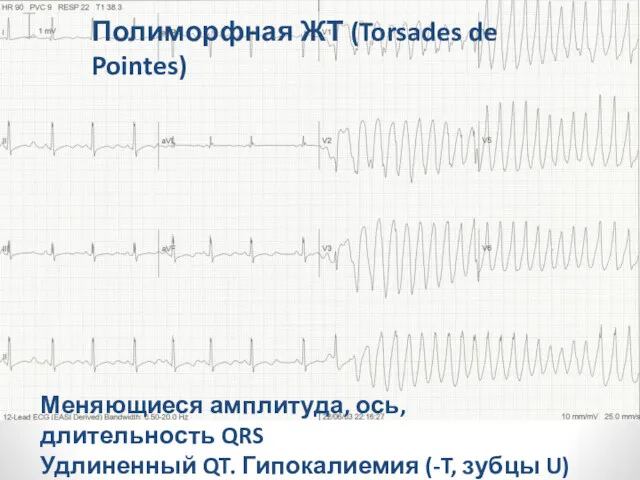 Полиморфная ЖТ (Torsades de Pointes) Меняющиеся амплитуда, ось, длительность QRS Удлиненный QT. Гипокалиемия (-T, зубцы U)