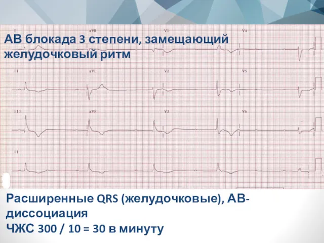 АВ блокада 3 степени, замещающий желудочковый ритм Расширенные QRS (желудочковые),