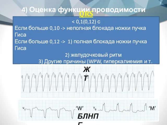 4) Оценка функции проводимости QRS Если больше 0,10 -> неполная