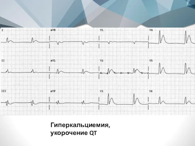 Гиперкальциемия, укорочение QT