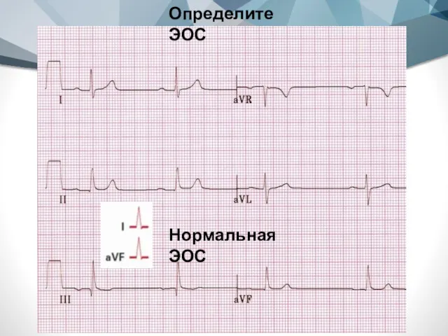 Определите ЭОС Нормальная ЭОС