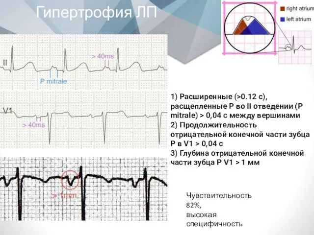 Гипертрофия ЛП 1) Расширенные (>0.12 с), расщепленные P во II