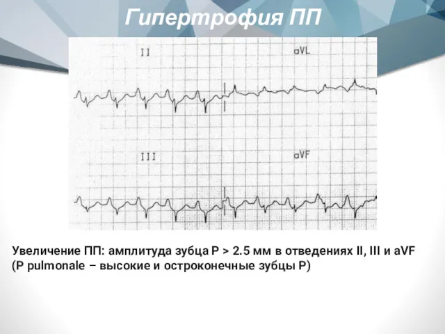 Гипертрофия ПП Увеличение ПП: амплитуда зубца P > 2.5 мм