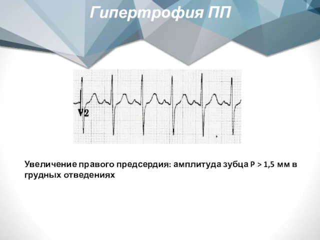 Гипертрофия ПП Увеличение правого предсердия: амплитуда зубца P > 1,5 мм в грудных отведениях