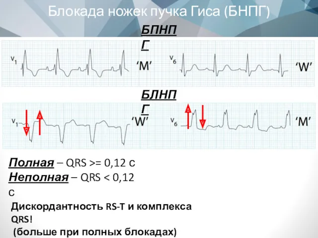 Блокада ножек пучка Гиса (БНПГ) БПНПГ БЛНПГ Полная – QRS