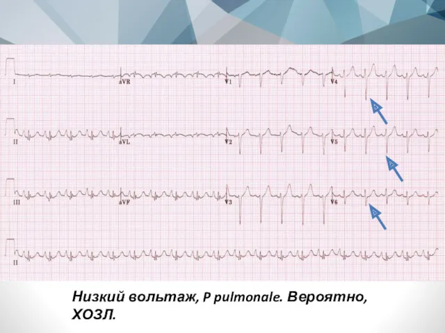 Низкий вольтаж, P pulmonale. Вероятно, ХОЗЛ.