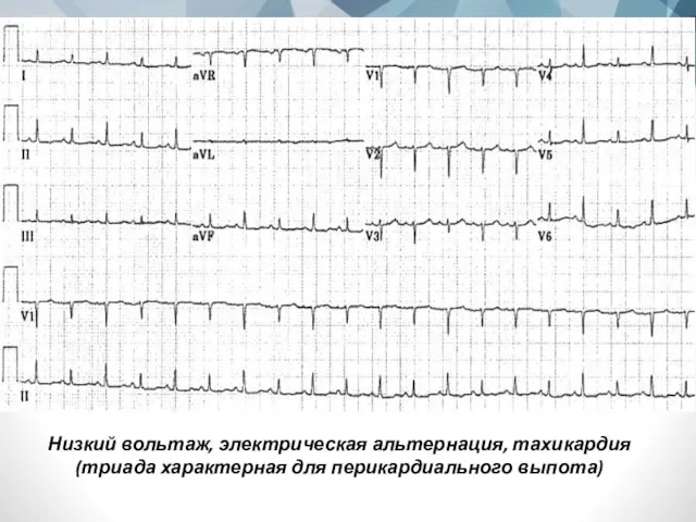 Низкий вольтаж, электрическая альтернация, тахикардия (триада характерная для перикардиального выпота)