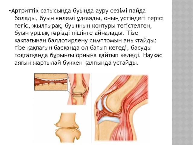 -Артриттік сатысында буында ауру сезімі пайда болады, буын көлемі ұлғаяды,