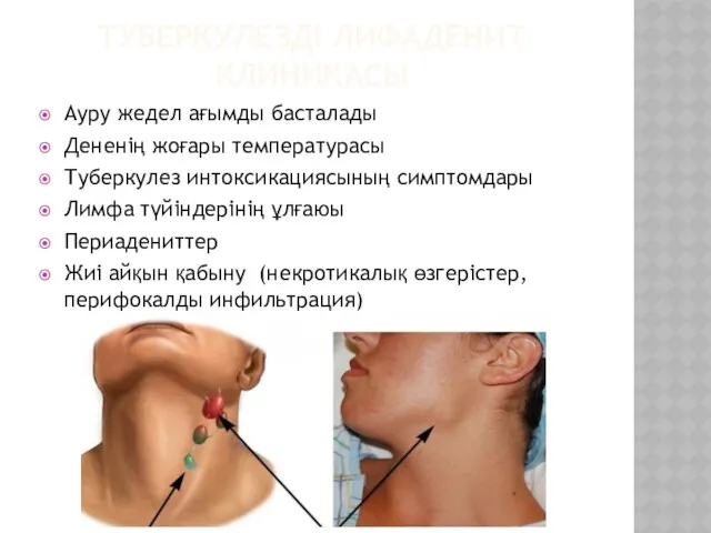 ТУБЕРКУЛЕЗДІ ЛИФАДЕНИТ КЛИНИКАСЫ Ауру жедел ағымды басталады Дененің жоғары температурасы