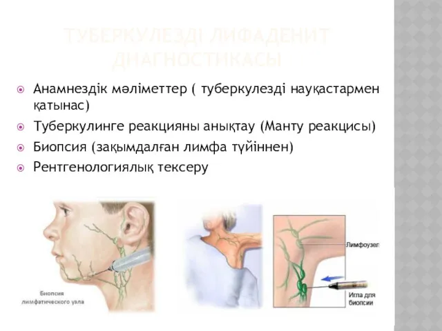 ТУБЕРКУЛЕЗДІ ЛИФАДЕНИТ ДИАГНОСТИКАСЫ Анамнездік мәліметтер ( туберкулезді науқастармен қатынас) Туберкулинге