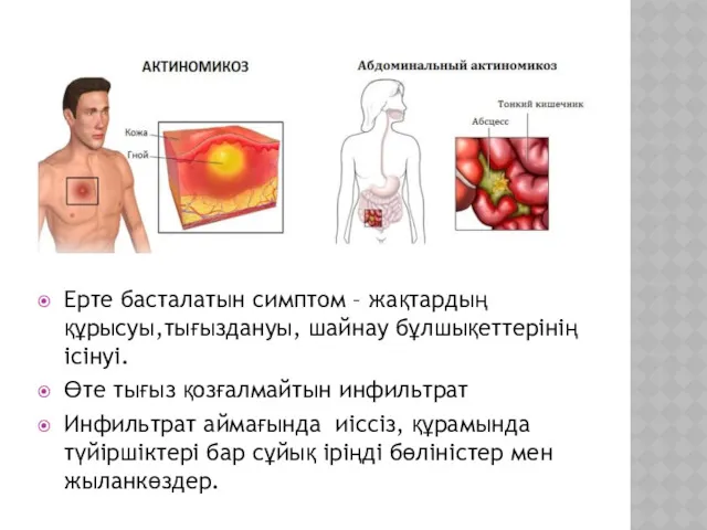 Ерте басталатын симптом – жақтардың құрысуы,тығыздануы, шайнау бұлшықеттерінің ісінуі. Өте тығыз қозғалмайтын инфильтрат