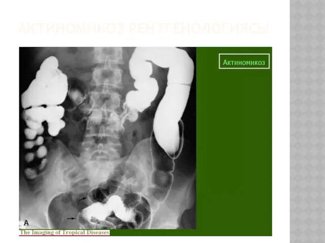 АКТИНОМИКОЗ РЕНТГЕНОЛОГИЯСЫ