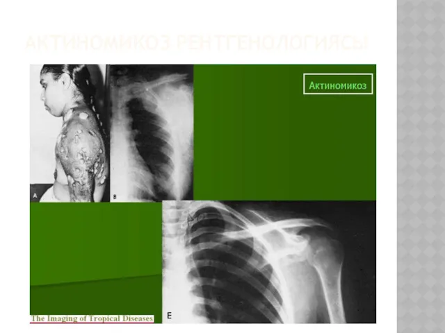 АКТИНОМИКОЗ РЕНТГЕНОЛОГИЯСЫ