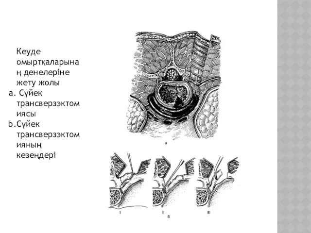 Кеуде омыртқаларынаң денелеріне жету жолы Сүйек трансверзэктомиясы Сүйек трансверзэктомияның кезеңдері