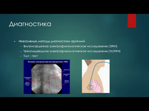 Диагностика Инвазивные методы диагностики аритмий Внутрисердечное электрофизиологическое исследование (ЭФИ) Чреспищеводное электрофизиологическое исследование (ЧпЭФИ) Тилт – тест