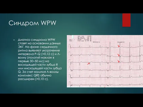 Синдром WPW Диагноз синдрома WPW ставят на основании данных ЭКГ. На фоне сердечного