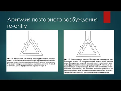 Аритмия повторного возбуждения re-entry