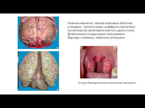 Гнойный менингит: мягкие мозговые оболочки утолщены, тусклого вида, диффузно пропитаны