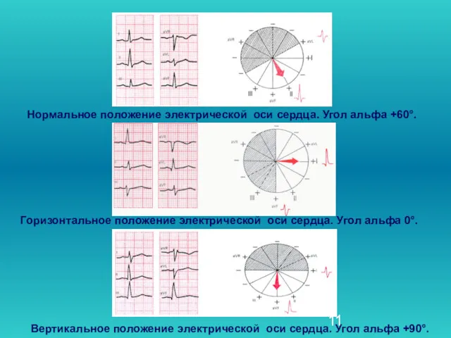 Горизонтальное положение электрической оси сердца. Угол альфа 0°. Вертикальное положение