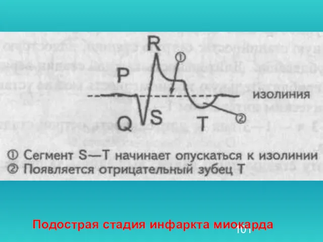 Подострая стадия инфаркта миокарда