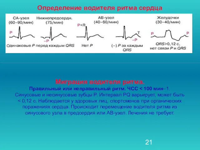 Миграция водителя ритма. Правильный или неправильный ритм. ЧСС Синусовые и