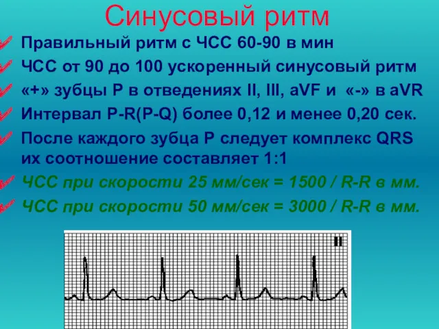 Синусовый ритм Правильный ритм с ЧСС 60-90 в мин ЧСС